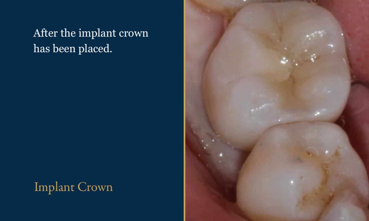 Dental Crowns, Bridges & Implants | Dentistry on George