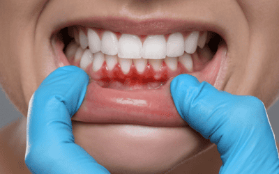 Understanding Gum Disease and Periodontitis: A Complete Guide