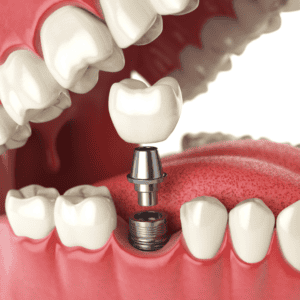 Dental Implant