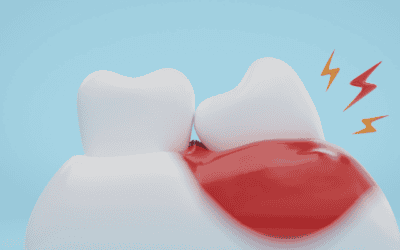 A Guide To Managing Wisdom Teeth